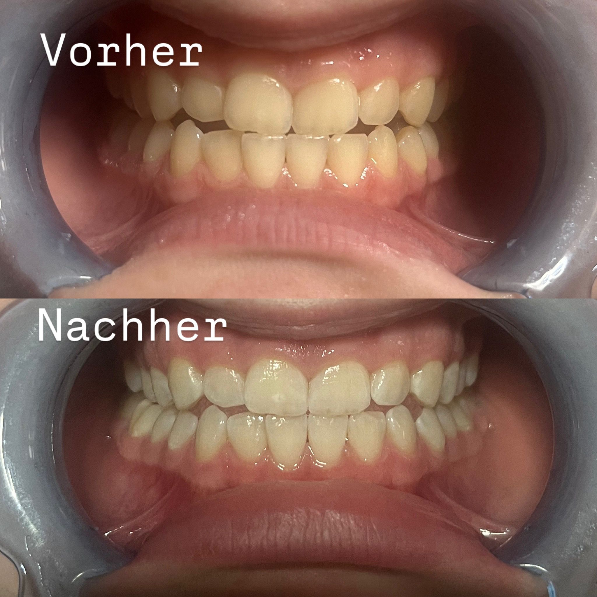 Zahnbleaching